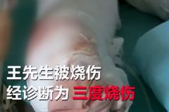 不慎引燃酒精桶，男子家中吃烧烤吃成三度烧伤[多图]