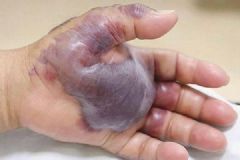 韩国男子吃生鱼寿司感染细菌，一条手臂被截肢[多图]