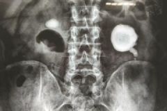 男子左肾长出“荷包蛋”结石:频加班爱喝浓茶[多图]