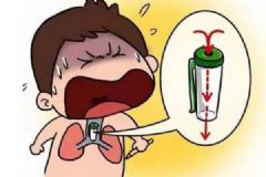 49岁女子咳嗽不止，从肺里取出9岁时误吞的笔帽[多图]