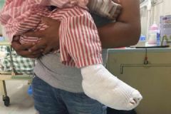 2岁女童医院乘扶梯被咬碎脚拇趾，医院:穿了洞洞鞋[多图]