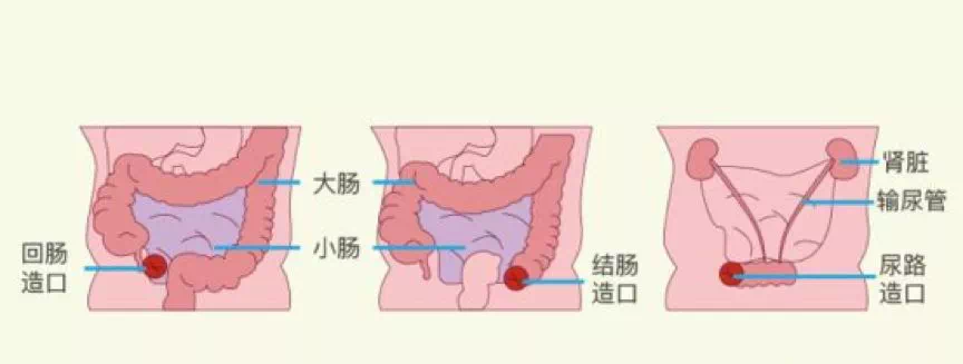 康维德中国携手京东健康于世界造口日开启造口减负计划