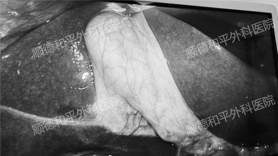 警惕反复右上腹隐痛！这可能是胆囊结石的“警报”