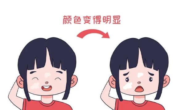 白癜风反反复复该怎么办，推荐东莞博润白癜风医院